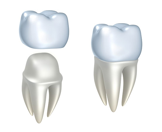 dental crown mississauga on cawthra