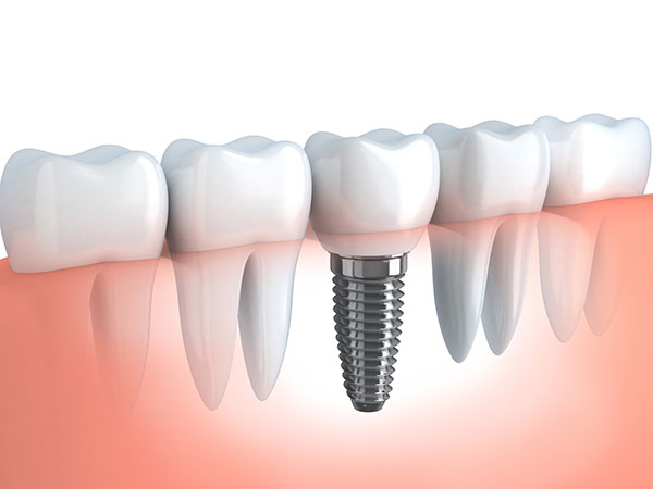 Advantages Of Dental Implants