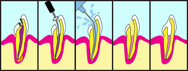 root canal steps in mississauga