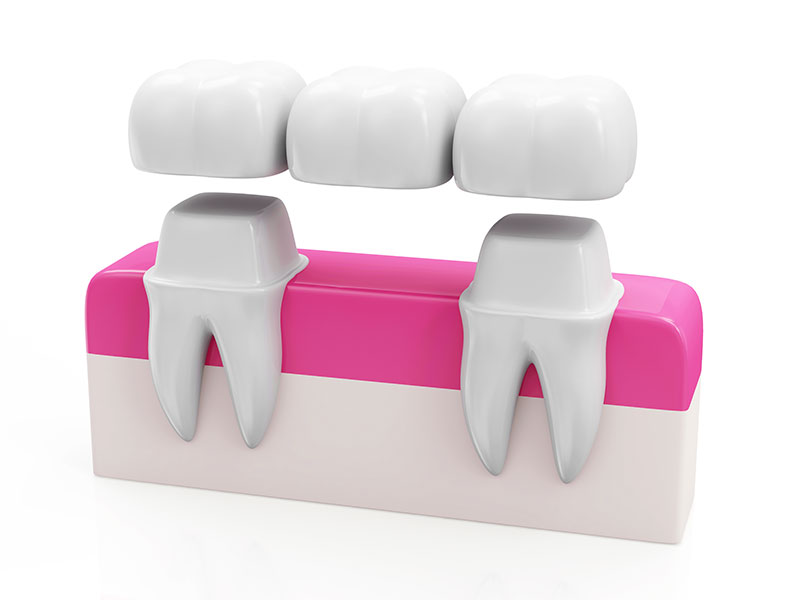 dental bridge mississauga dentist cawthra