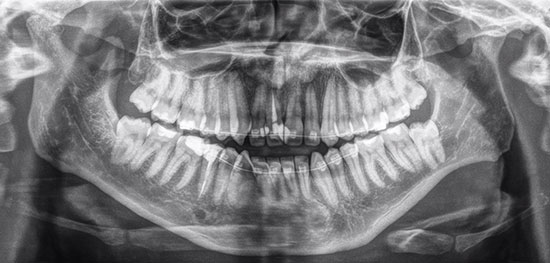 example xray showing wisdom teeth mississauga dentist