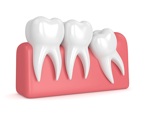 Wisdom Teeth Extraction In Mississauga