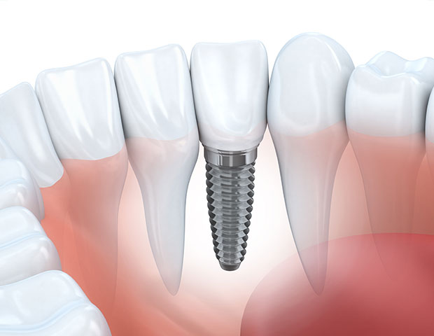 tooth replacement option mississauga dentist