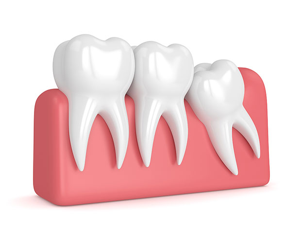 do i need my wisdom teeth mississauga dentist