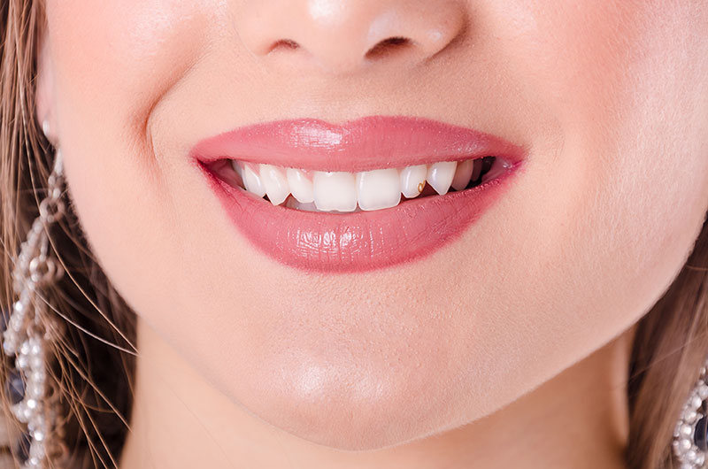 How Peg-Shaped Teeth are Treated