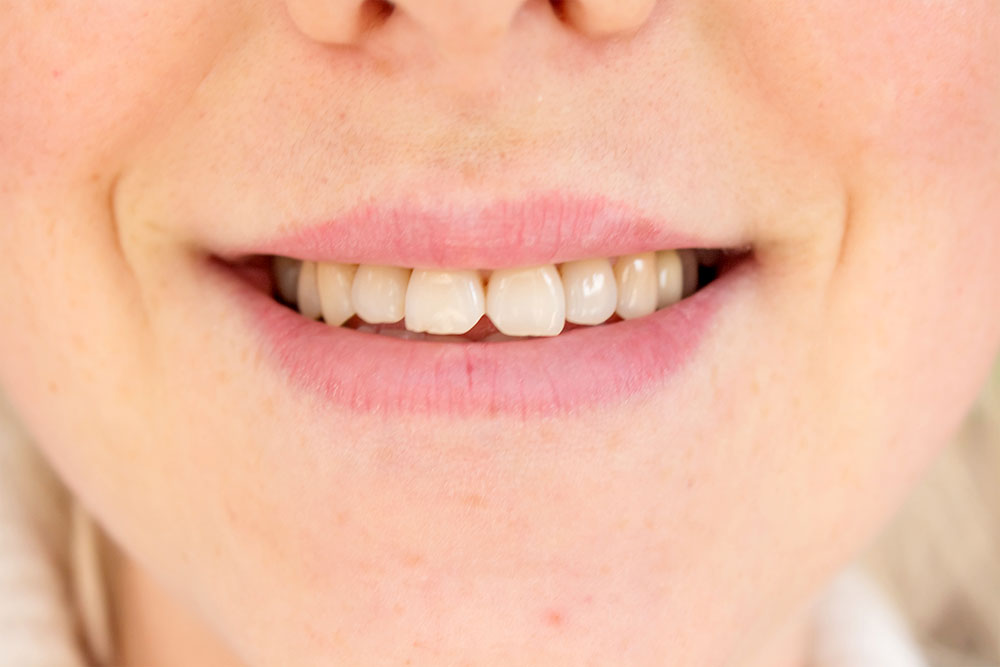 How To Fix A Chipped Tooth And Restore Your Smile