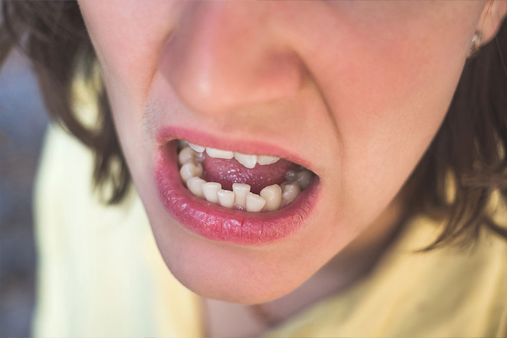 Can Crowded Teeth Affect Your Oral Health?