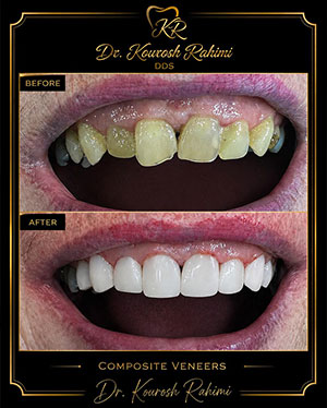 dental-veneers-before-after